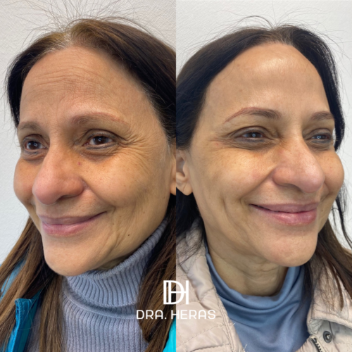 BOTOX + SCULPTRA